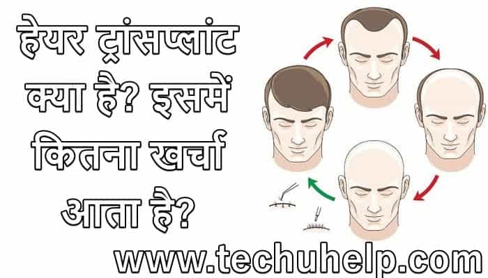 हेयर ट्रांसप्लांट क्या है? खर्च, लाभ, नुकसान, कैसे किया जाता है?